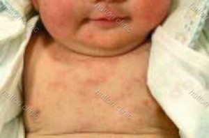 赤ちゃん湿疹