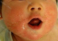 乳幼児食物アレルギー