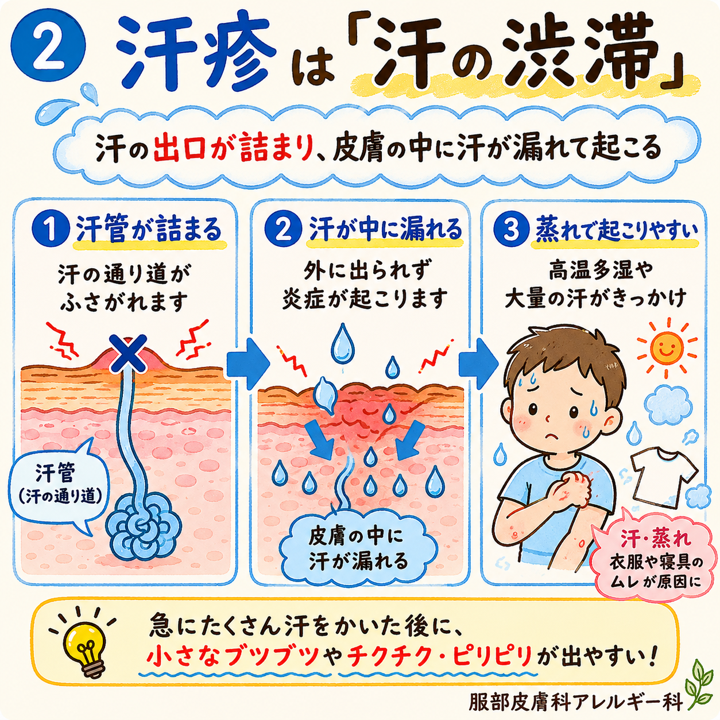 汗疹は汗の渋滞