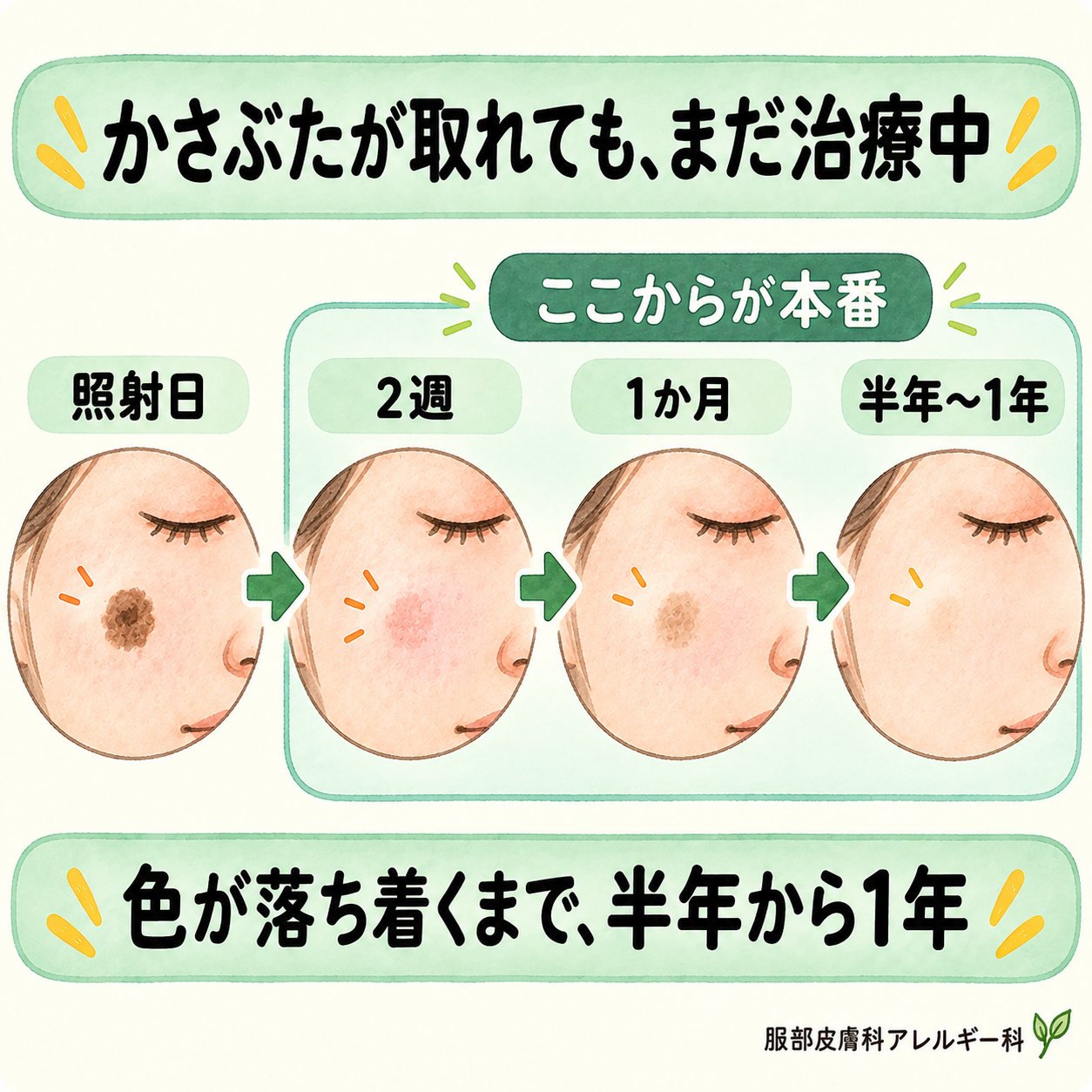 色が落ち着くまで半年から1年かかる