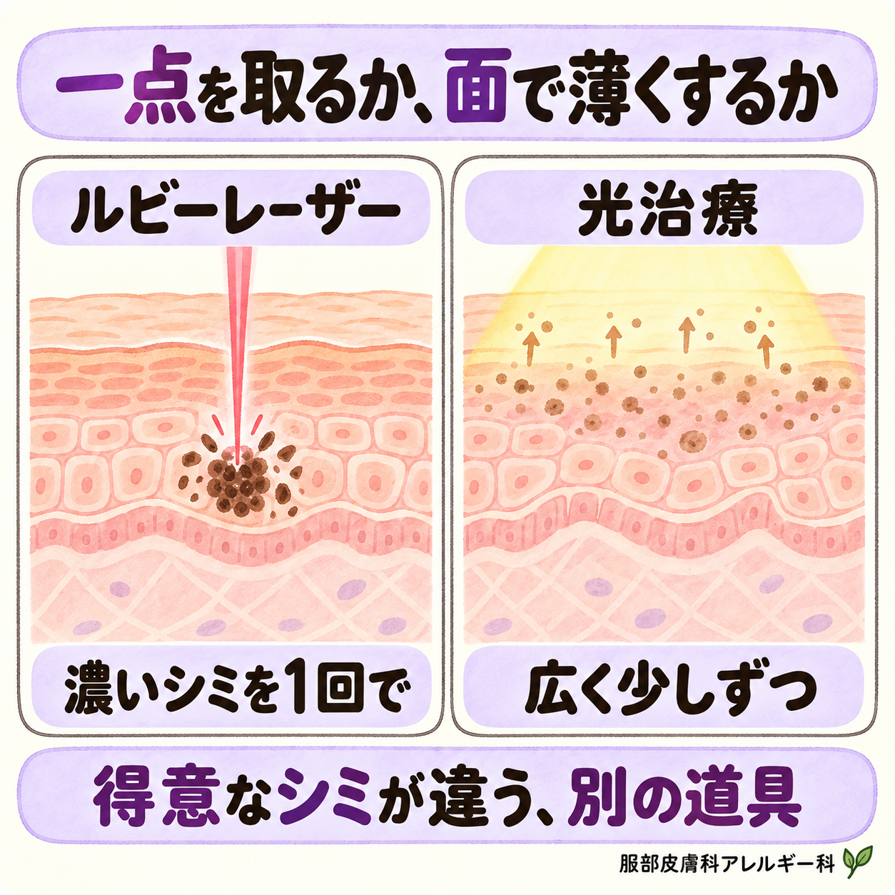 一点を取るか、面で薄くするか