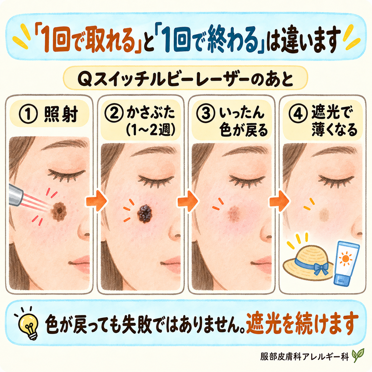 レーザー照射のあと、いったん色が戻ってから薄くなる経過