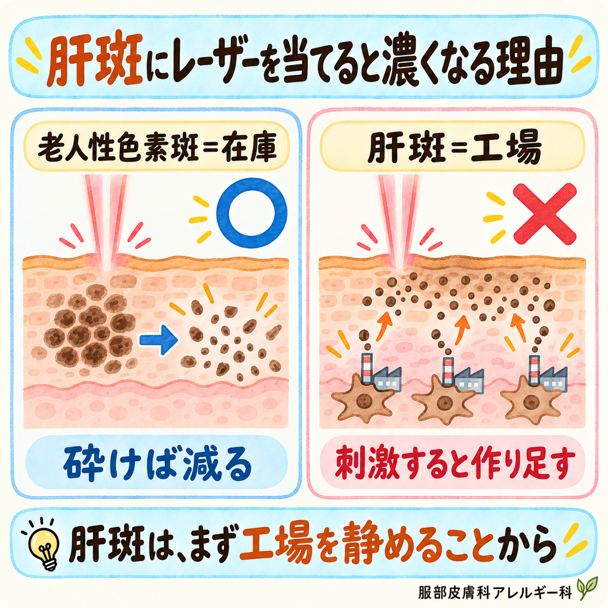 肝斑にレーザーを当てると色素を作り足してしまう仕組み
