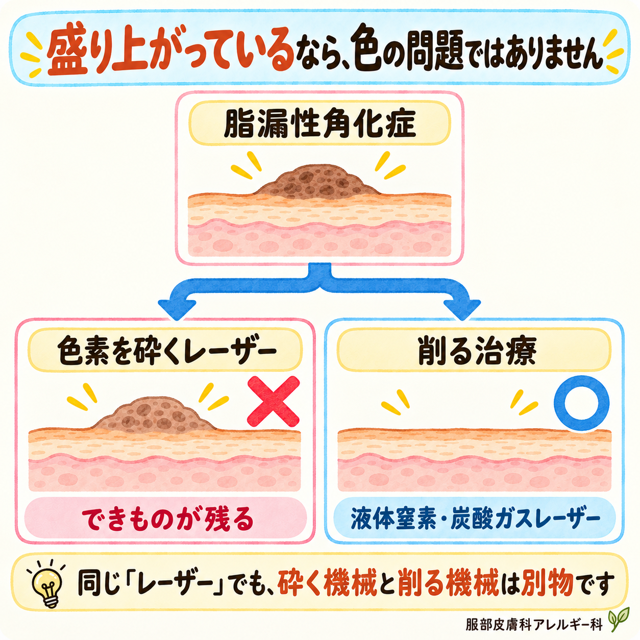 盛り上がったシミは色素を砕くレーザーでは取れない