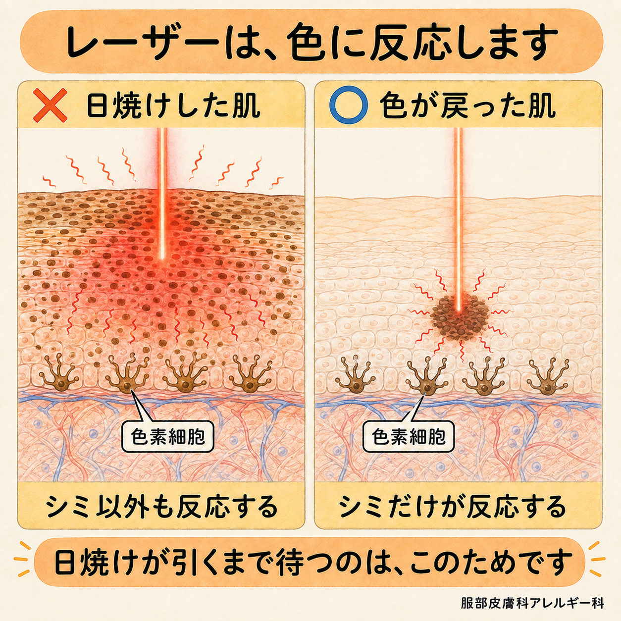 レーザーは色に反応する。日焼けした肌ではシミ以外も反応し、色が戻った肌ではシミだけが反応する