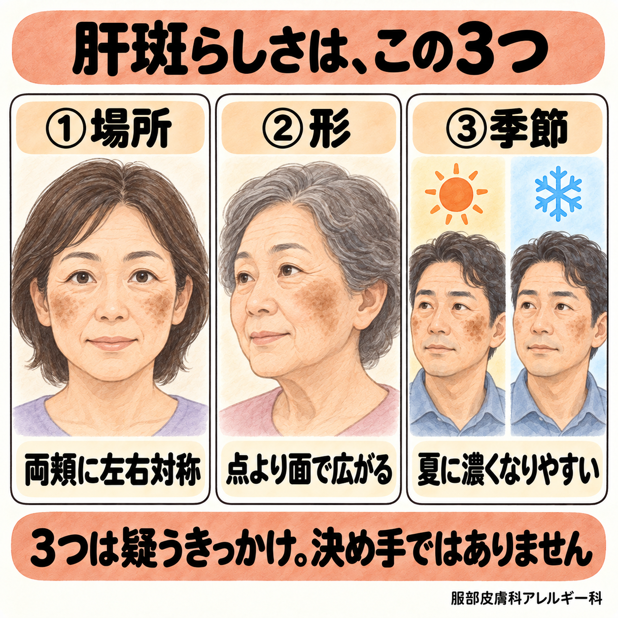 肝斑らしさは場所・形・季節の3つ