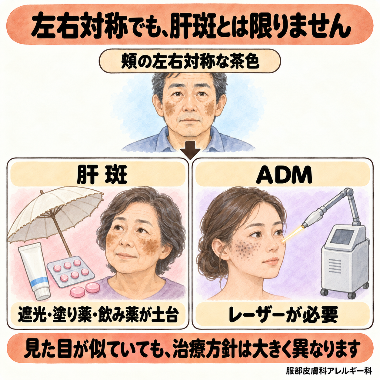 左右対称の茶色は肝斑とADMで治療方針が異なる