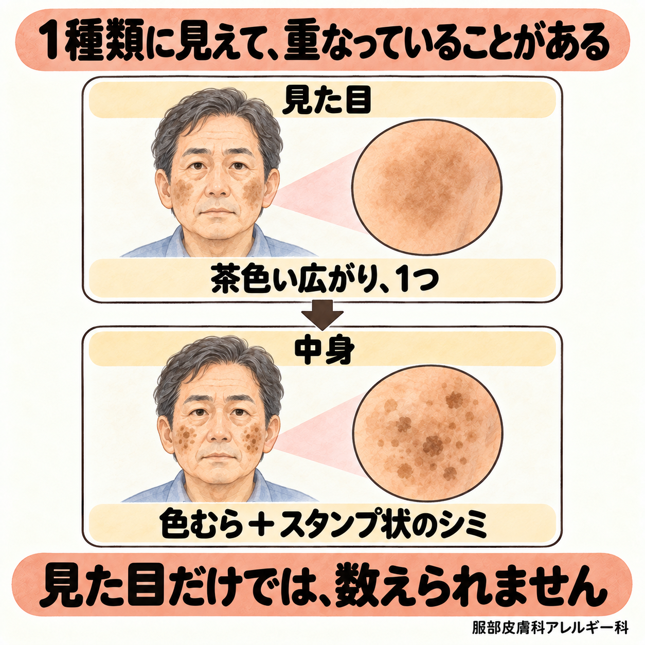 1種類に見えて、肝斑と普通のシミが重なっていることがある