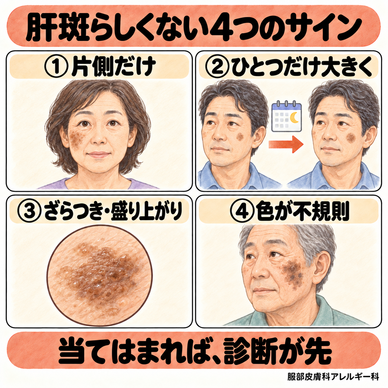 肝斑らしくない4つのサイン