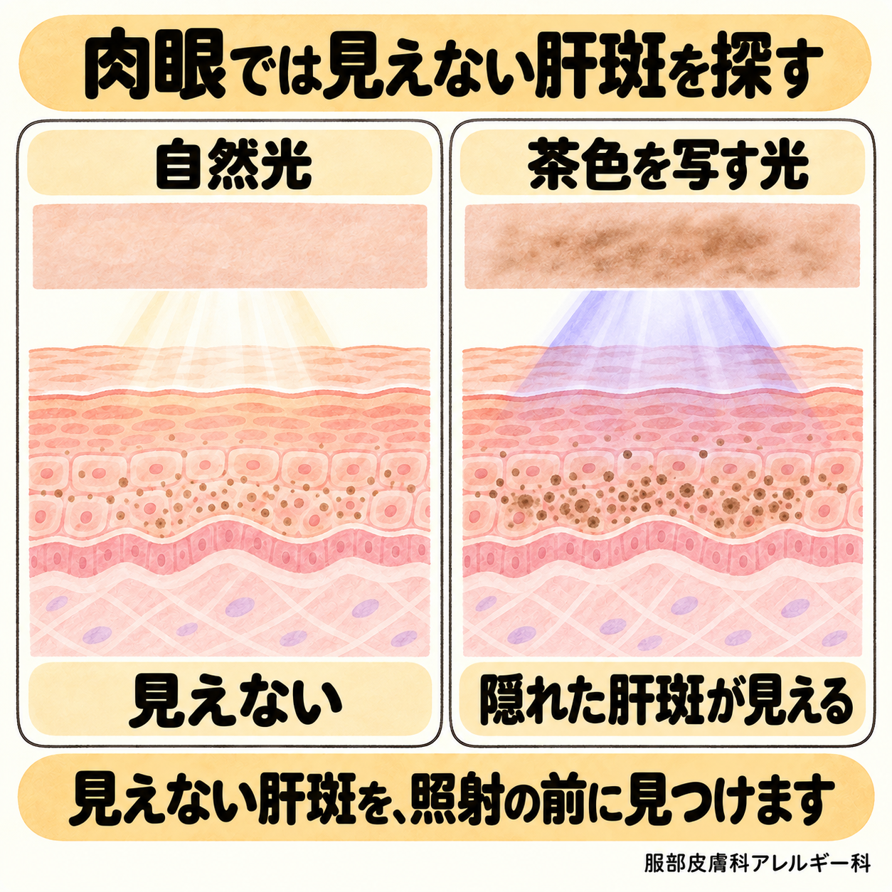 肉眼では見えない肝斑を探す