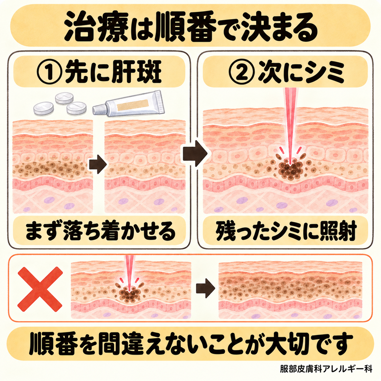 肝斑を落ち着かせてからシミに照射